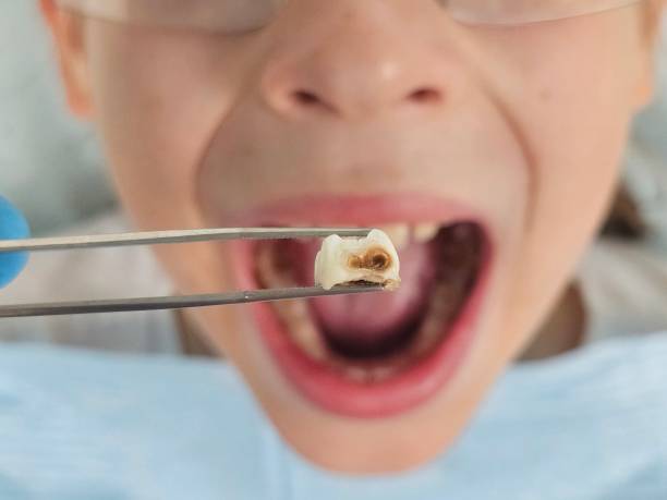 Best Emergency Tooth Extraction in Wayland, IA